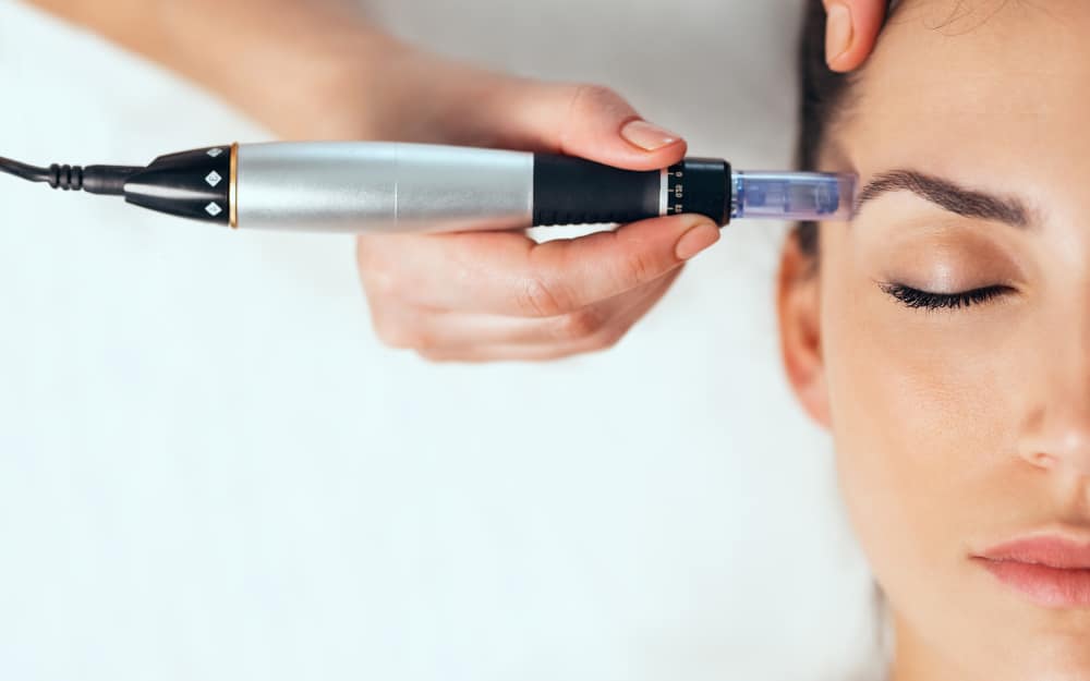 Microneedling Essex