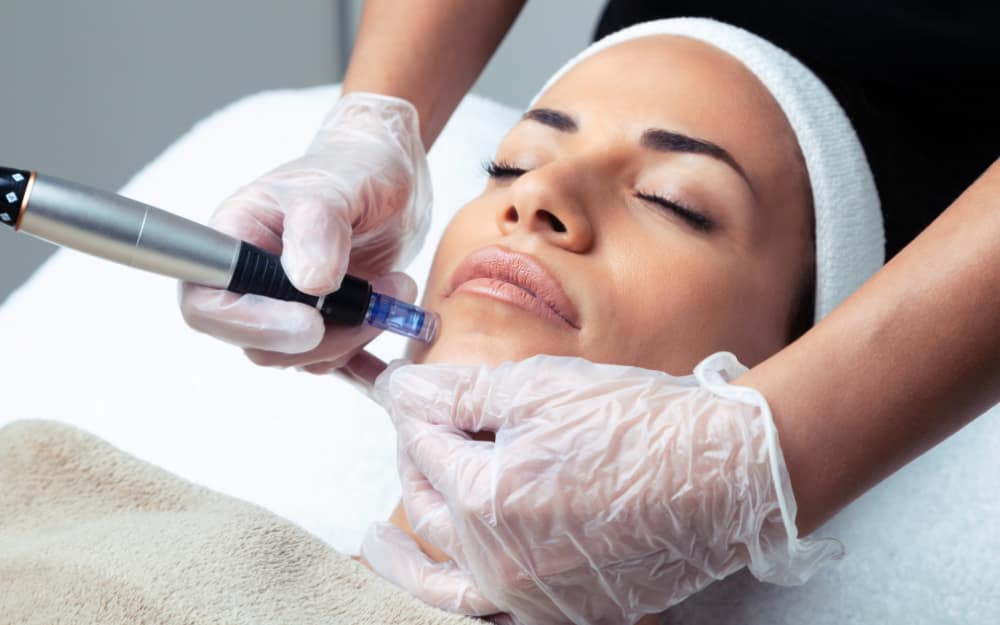 Microneedling Essex