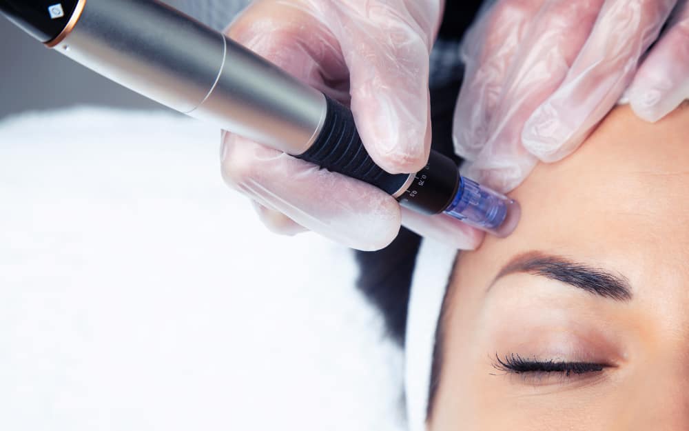Microneedling Essex