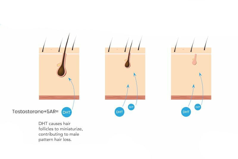 Hair follicle miniaturization process illustrated.