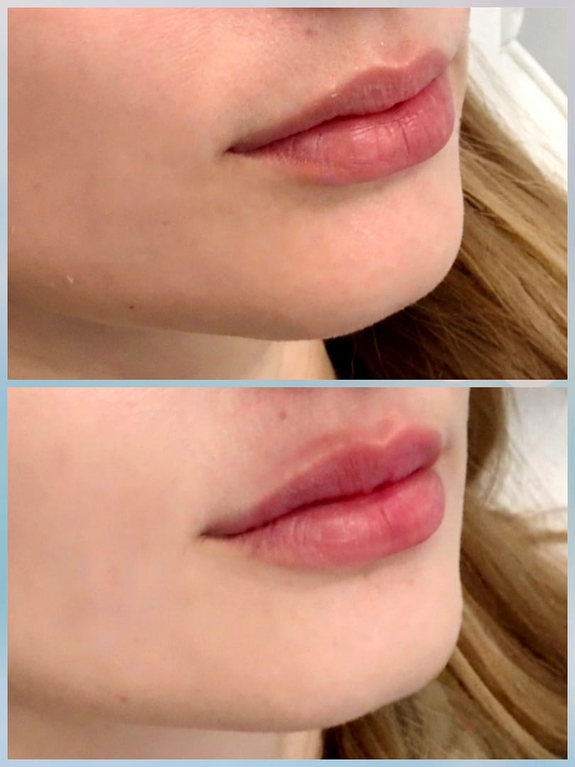 Natural lip filler treatment result showing subtle volume enhancement and soft tissue integration
