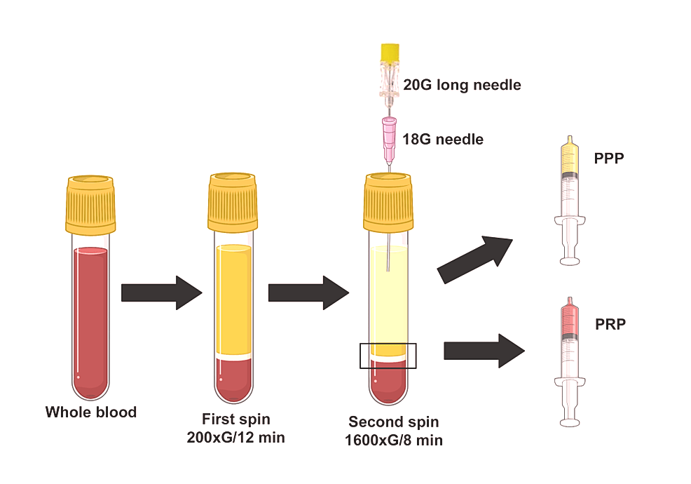 Blood processing steps for PRP preparation