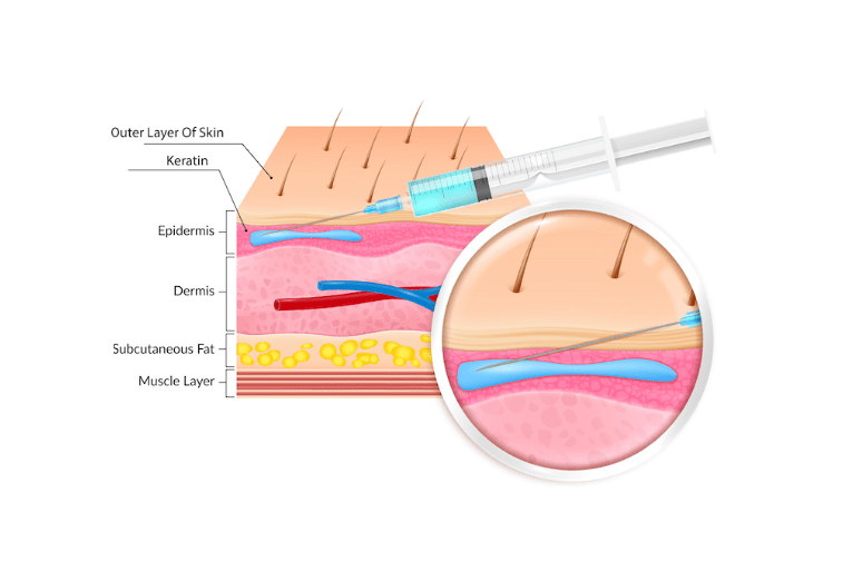 Diagram of intradermal injection layers for Dutasteride Hair Mesotherapy